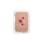 Pocketwunde Granuloma pyogenicum