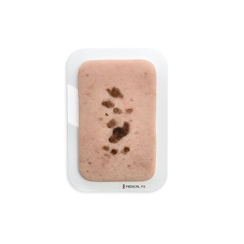 Pocketwound Seborrheic keratosis