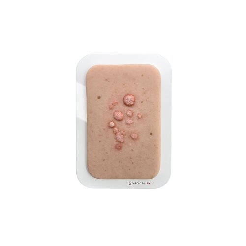 Pocketwound Common Wart
