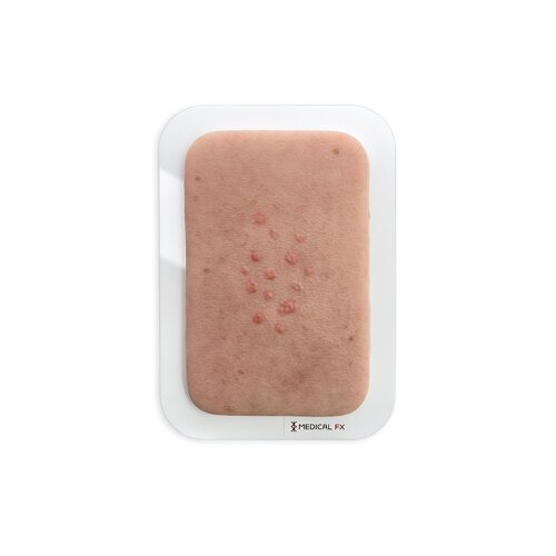 Pocketwound Sebaceus hyperplasia