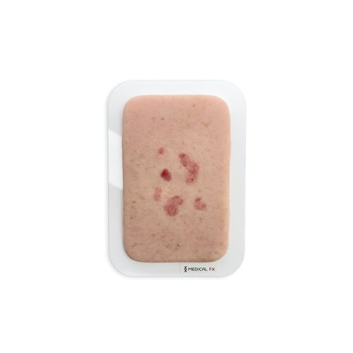 Pocketwunde Superfizielles Basaliom