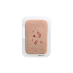 Pocketwunde Superfizielles Basaliom