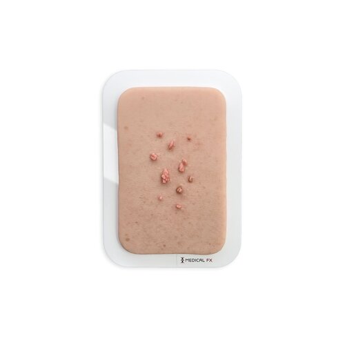 Pocketwunde Fibroma pendulans (Weiches Fibrom)