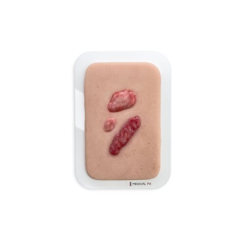 Pocketwound Keloid Scars