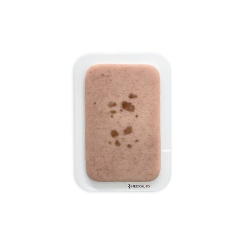 Pocketwound Senile Lentigo (Age Spot)
