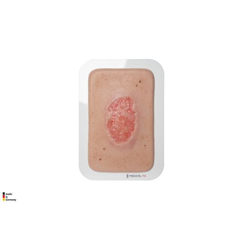 Pocketwunde Granulation mit Fibringitter