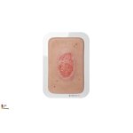 Pocketwunde Granulation mit Fibringitter