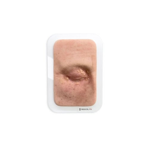 Pocketwound Xanthelasma - without hair