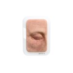 Pocketwound Xanthelasma (Lidkn&ouml;tchen) - ohne Behaarung