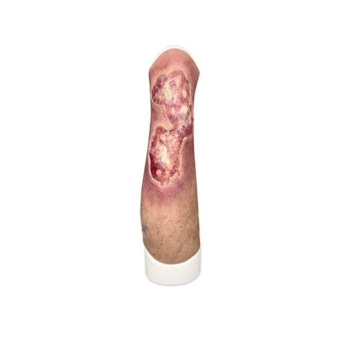 Sleeve Leg with Gaiter Ulcer - wound with coating
