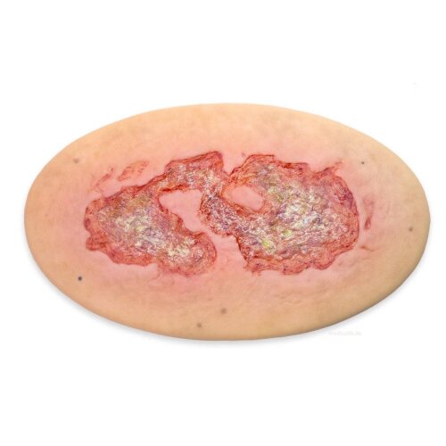 Stick-On Large Venous Leg Ulcer (Ulcus Cruris) - wound with coating