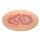 Stick-On Large Venous Leg Ulcer (Ulcus Cruris) - wound with coating
