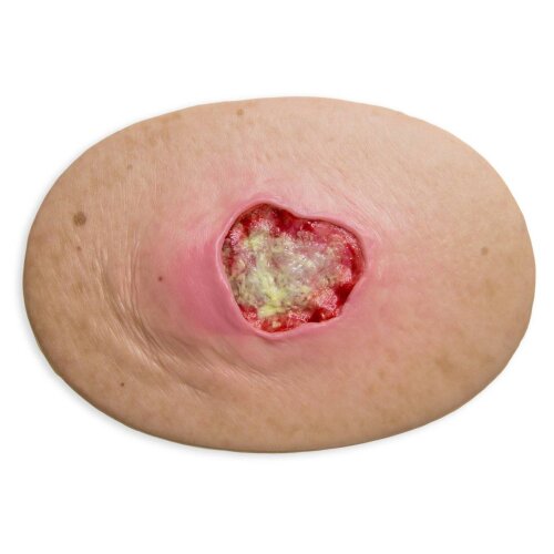 Stick-On Medium Pressure Ulcer Stage 3 - wound with coating