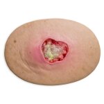 Stick-On Medium Pressure Ulcer Stage 3 - wound with coating