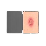 Tabletwunde Ulcer Chronische Wunde
