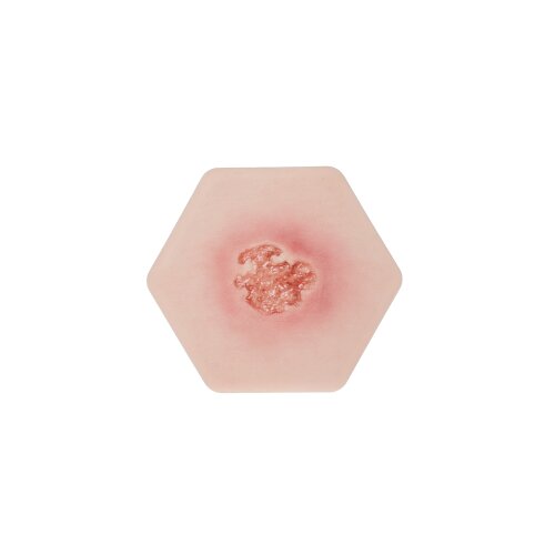 Hexapad Dekubitus Grad 2 flach