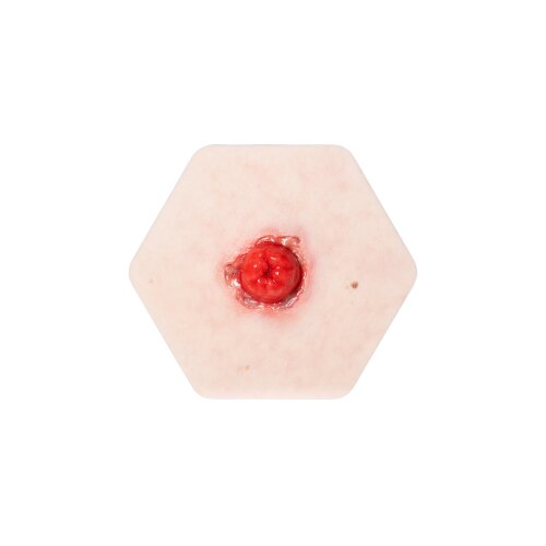 Hexapad Stoma mit Dehiszenz