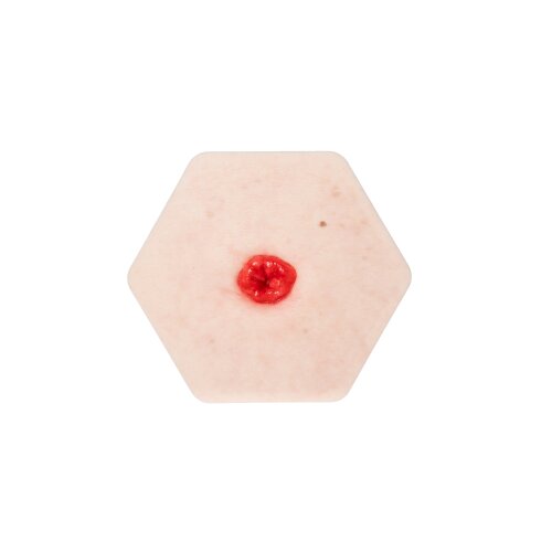 Hexapad Stoma in einer Mulde