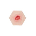 Hexapad Hypergranulation