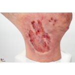 Base Model Diabetic Foot Syndrome with 7 Wounds - clean wound