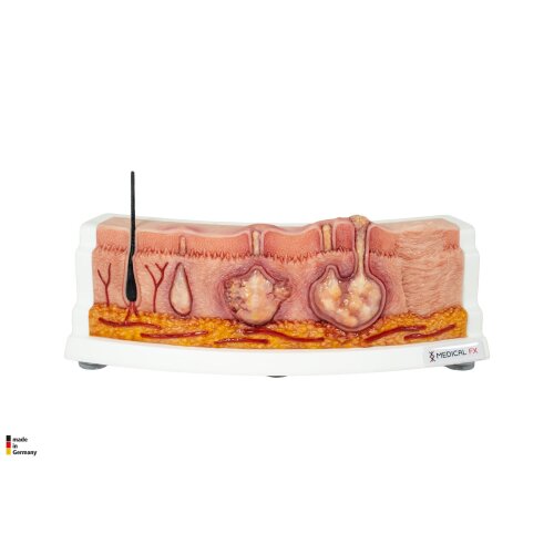 Rahmenmodell Hidradenitis Suppurativa (gebogener Querschnitt)