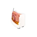 Rahmenmodell Hidradenitis Suppurativa (gebogener Querschnitt)