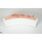 Rahmenmodell Hidradenitis Suppurativa (gebogener Querschnitt)