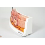 Rahmenmodell Hidradenitis Suppurativa (gebogener Querschnitt)