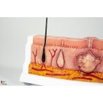 Frame Model Hidradenitis Suppurativa