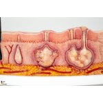 Rahmenmodell Hidradenitis Suppurativa (gebogener Querschnitt)