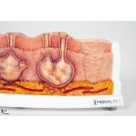 Rahmenmodell Hidradenitis Suppurativa (gebogener Querschnitt)