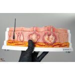 Rahmenmodell Hidradenitis Suppurativa (gebogener Querschnitt)