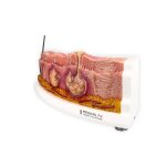 Rahmenmodell Hidradenitis Suppurativa (gebogener Querschnitt)