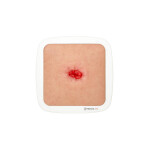 Rahmenmodell Stoma in einer Mulde