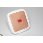 Rahmenmodell Stoma in einer Mulde