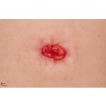 Frame model Stoma in a hollow