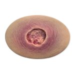 Stick-On Medium Ulcer mit Unterminierung - saubere Wunde