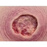 Stick-On Medium Ulcer mit Unterminierung - saubere Wunde