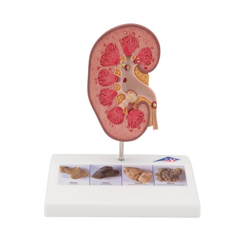 Kidney Stone Model - 3B Smart Anatomy
