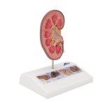 Kidney Stone Model - 3B Smart Anatomy