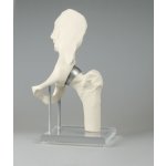 Hip joint model with resurfacing implant