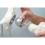 Hip joint model with resurfacing implant