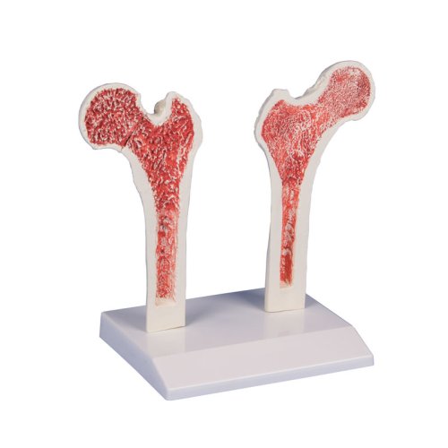 Osteoporose-Oberschenkel-Modell