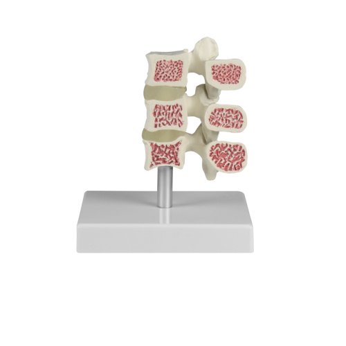 Osteoporosis vertebrae model, 3 vertebrae