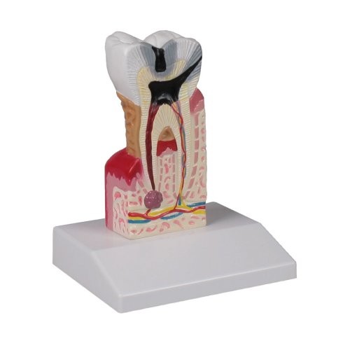 Dental caries model, 10 times life-size