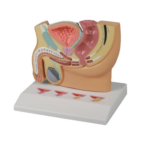 M&auml;nnlicher Becken-Modellschnitt mit Prostataerkrankungen