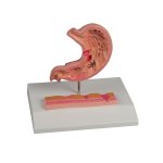 Stomach model with ulcers